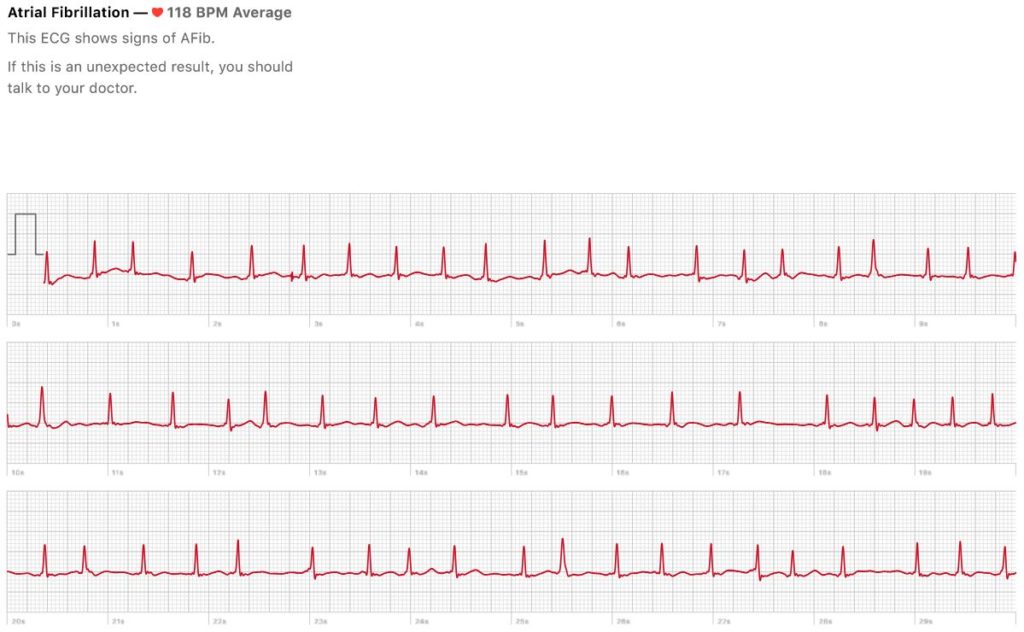 Ecg Feature Apple Watch Series 5 Save Life First Time 1