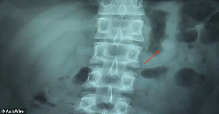 Accidentally Swallowed Airpods Keep Working